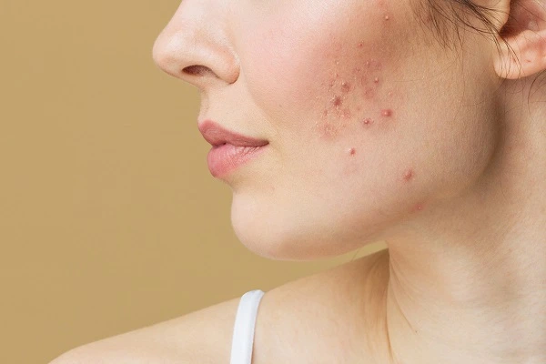 Collagen Peptides Cause Acne